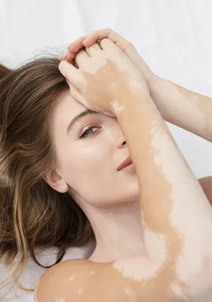 Vitiligo micropigmentacion isabel cordero