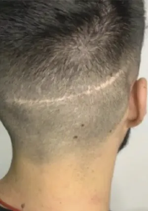 cicatrices capilares micropigmentacion isabel cordero