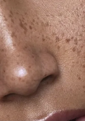 pecas y lunares micropigmentacion isabel cordero