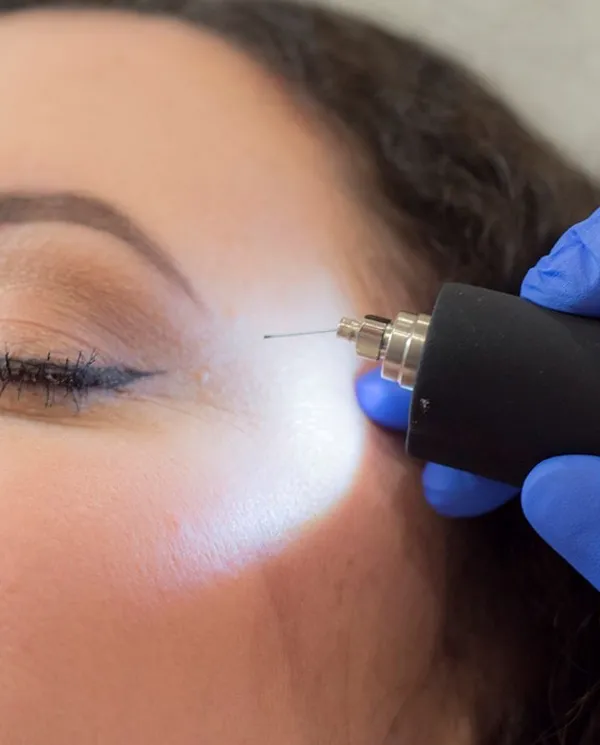 plasmapen detalle etetica natural isabel cordero