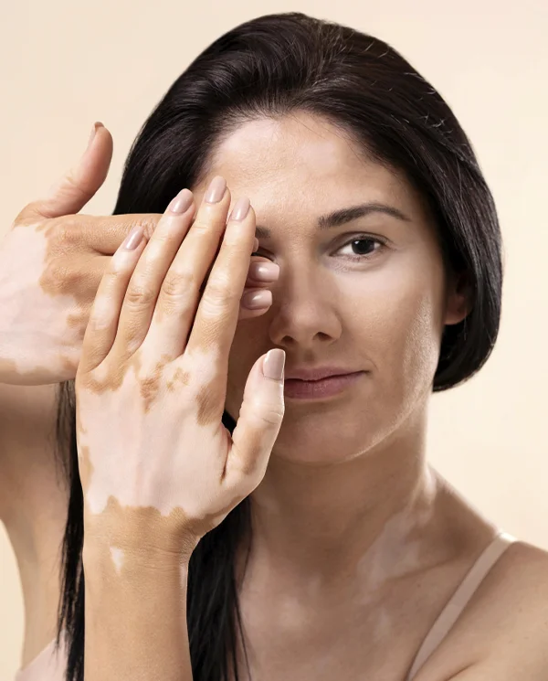 Vitiligo destacada isabel cordero